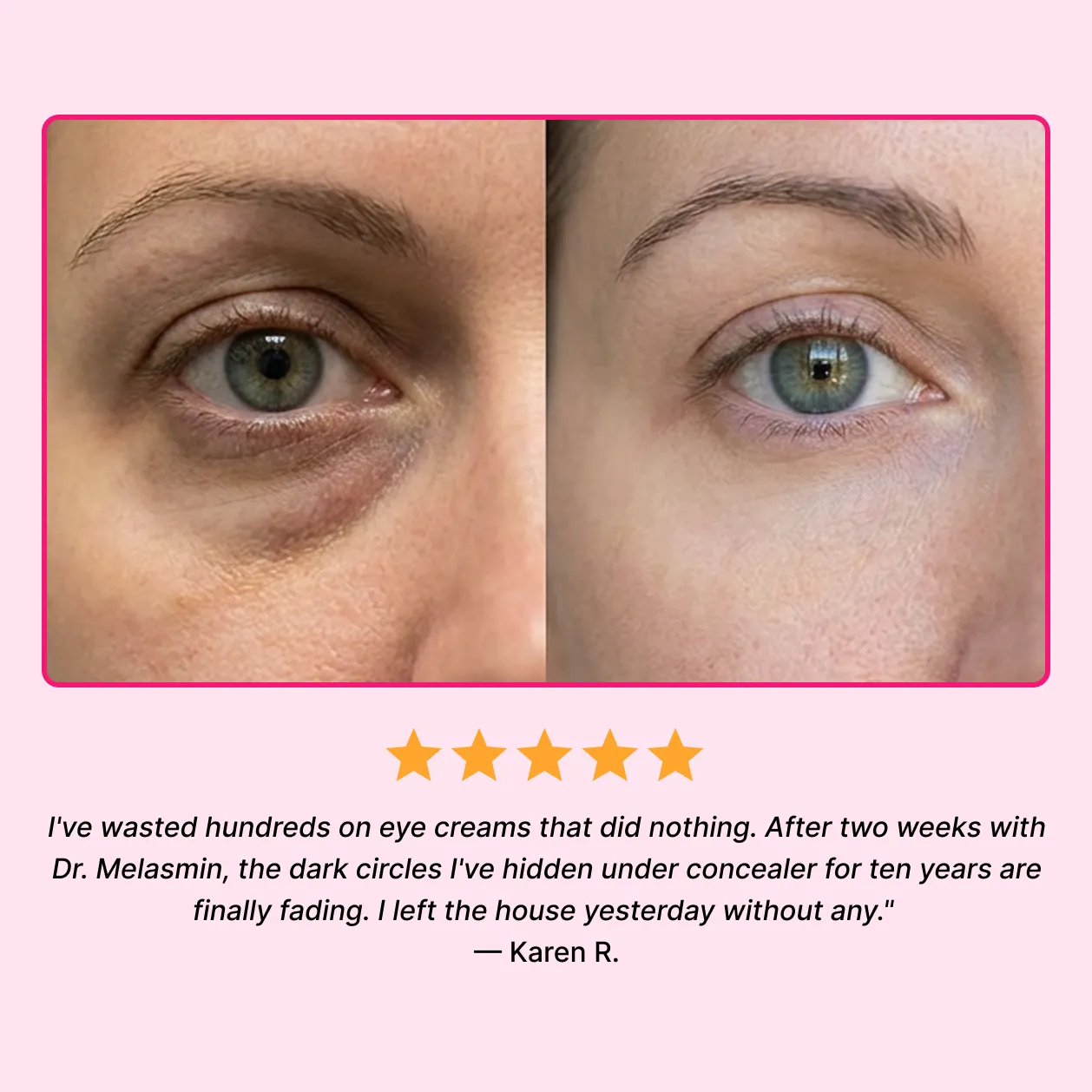 Under-eye close-up result